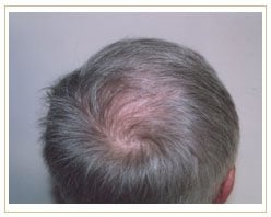 Slider image (4) ProHAIR Transplant Clinic